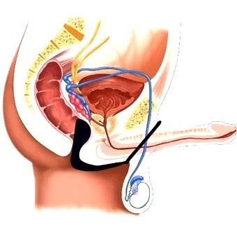 Plug Anal Estimulador Prostático Con